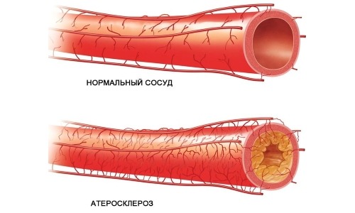 Атеросклеротические изменения брахиоцефальных артерий