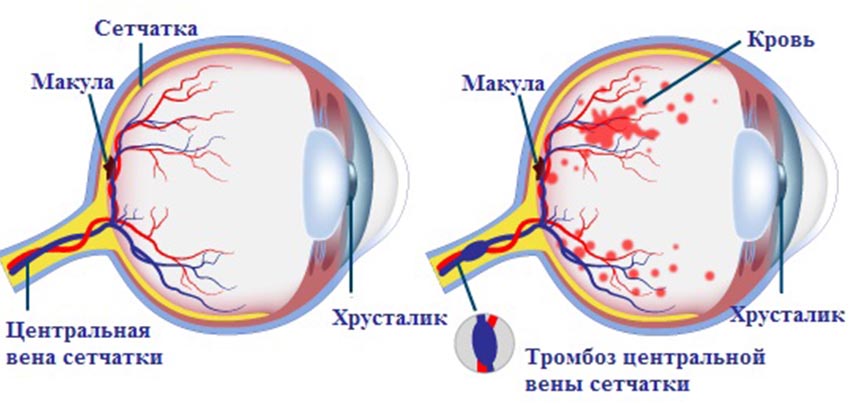 Тромбоз центральной вены сетчатки глаза – симптомы и лечение тромбоза ЦВС