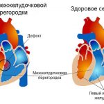 Сравнение здорового сердца и заболевания ДМЖП