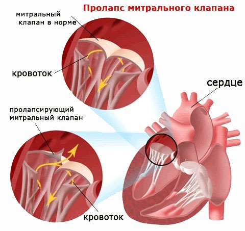 Пролапс митрального клапана и артериальное давление