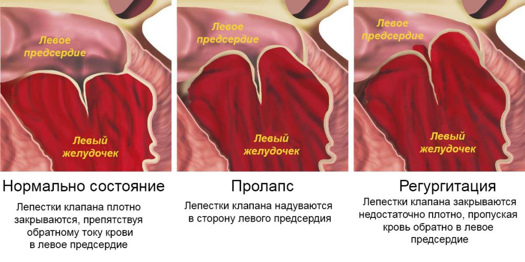 Пролапс митрального клапана что