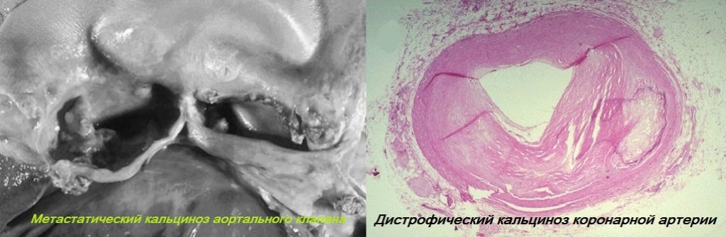 Метастатический кальциноз аортального клапана и дистрофический кальциноз коронарной артерии