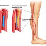 Проявление атеросклероза на ногах