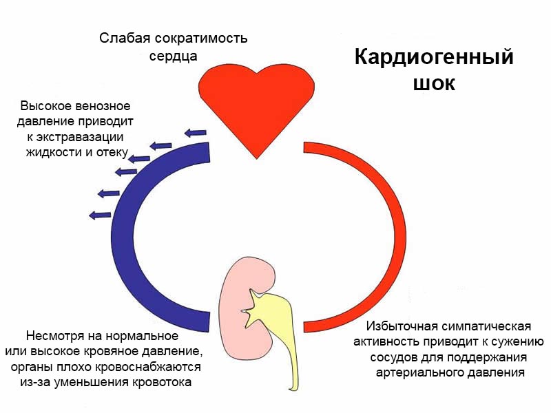 Механизм действия кардиогенного шока