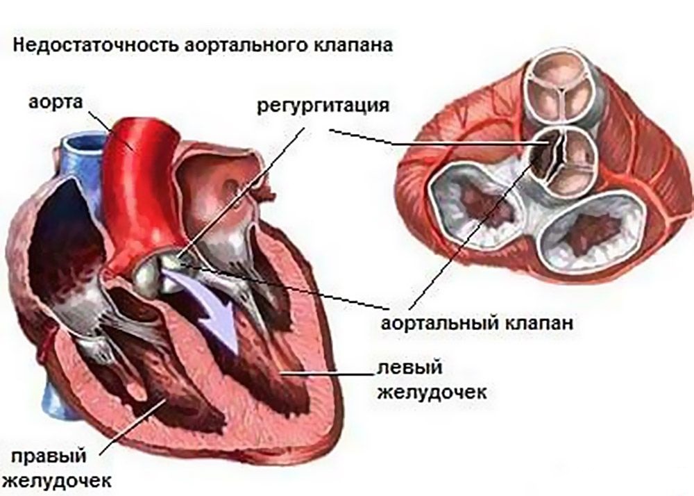 Недостаточность аортального клапана