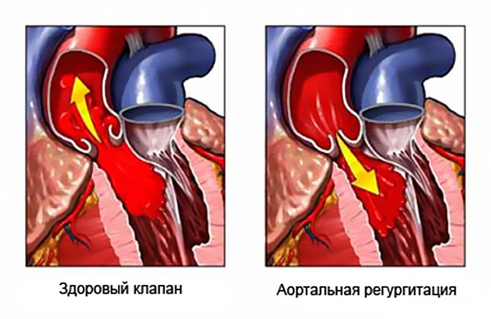 Инфекционный эндокардит аортального клапана