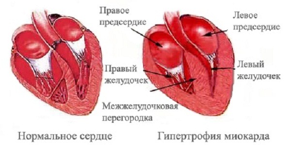 Гипертрофированное сердце