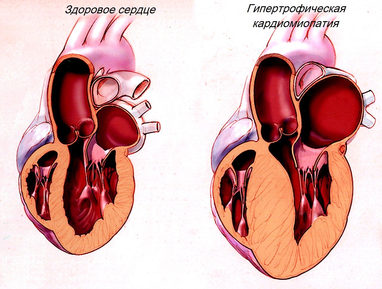 Гипертрофическая кардиомиопатия на разрезе сердца