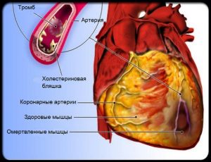 Как происходит инфаркт миокарда