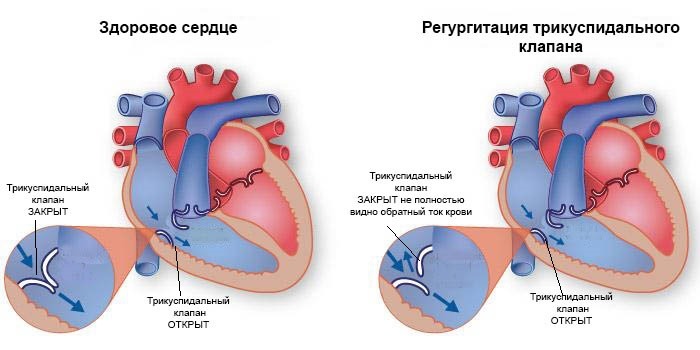 Регургитация трикуспидального клапана и здоровое сердце