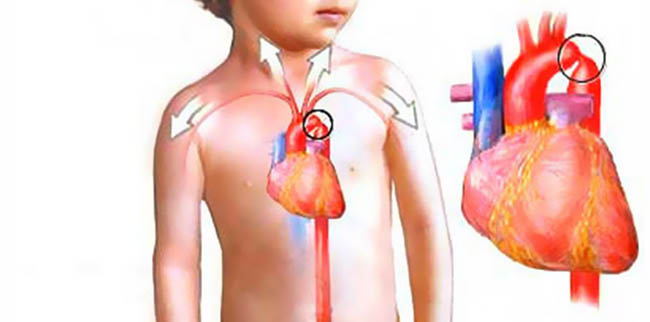 Коарктация аорты у ребенка