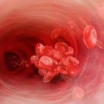 Тромбоэмболия легочной артерии симптомы лечение народными средствами thumbnail