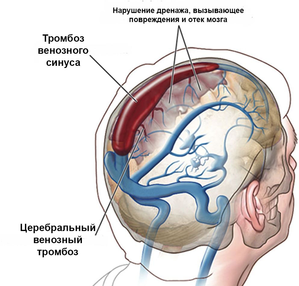 Тромбоз венозного синуса