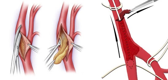 Тромбоэмболия легочной артерии симптомы лечение народными средствами