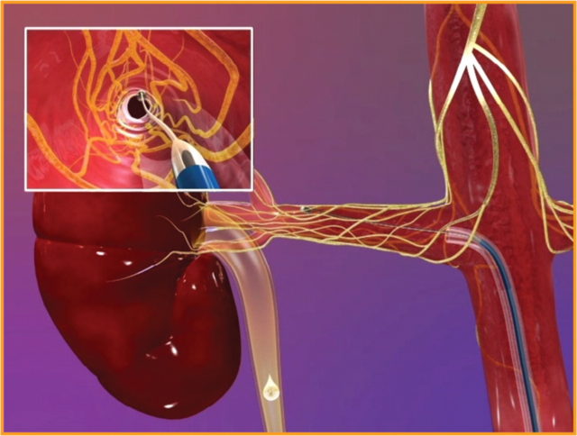 Нефрогенные артериальные гипертонии лечение