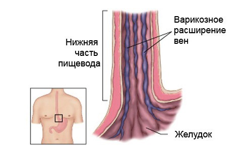 Варикозное расширение вен в желудке причины способы лечения