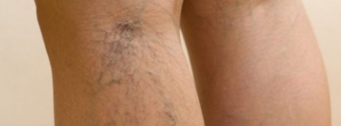 Что такое варикозное расширение вен на ногах