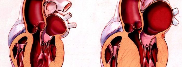Инфаркт миокарда в зоне левого желудочка: диагностика и лечение патологии