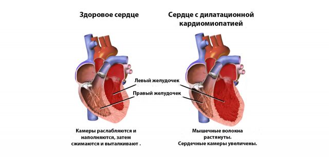 Противопоказания при диспластическая кардиопатия