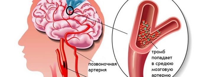 Образование тромба в сонной артерии: причины, опасность, диагностика и лечение