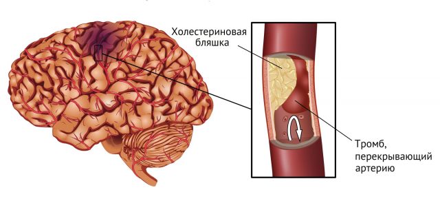 Атеротромботический инфаркт головного мозга в вбб что это такое