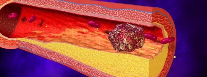 Признаки, лечение и прогноз при тромбозе нижней полой вены