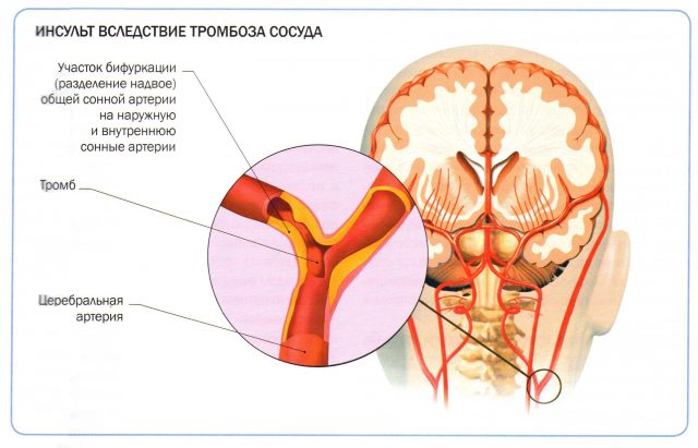 Инсульт тромб сонной артерии